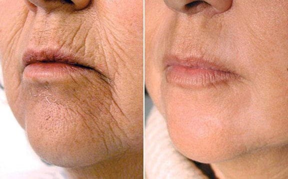 resurfacing laser non ablatif ASTRA avant