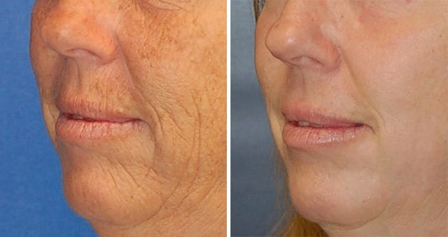 resurfacing laser non ablatif ASTRA avant
