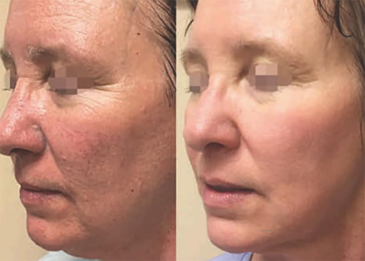 resurfacing laser non ablatif ASTRA avant apres