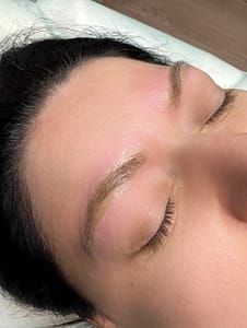 laser picoseconde esthétique ZENITH apres